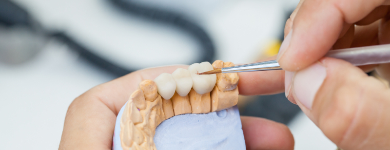 Dental Bridges Treatment - Dental World Clinic | Marietta, GA